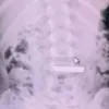 Menina de 5 anos engole barra de ouro e precisa de cirurgia de emerg�ncia