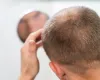 Cabelo, autoestima e sa�de: o lado emocional da calv�cie