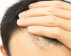 Cabelo transplantado cai? Tire todas as suas d�vidas