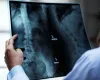 Osteoporose afeta homens e mulheres de formas diferentes: veja como prevenir a perda dos ossos
