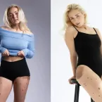 Jovem com manchas pelo corpo desabafa: 'Pensam que ca� na lama'