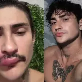 Influenciador 'Ken Humano' � internado depois de espremer uma espinha no rosto
