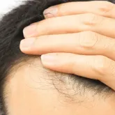 Cabelo transplantado cai? Tire todas as suas d�vidas