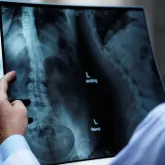 Osteoporose afeta homens e mulheres de formas diferentes: veja como prevenir a perda dos ossos