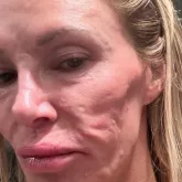 Brandi Glanville se submete a cirurgia extrema para retirar 'pele do rosto' e limpar infec��o misteriosa