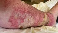 Perna de idoso inchou at� o tamanho de uma melancia ap�s mordida de aranha no Reino Unido