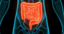 C�ncer de intestino em jovens aumenta e preocupa m�dicos