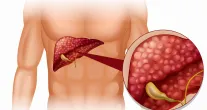 Campanha Julho Amarelo refor�a o combate �s hepatites virais em todo o Brasil