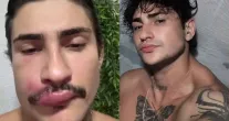 Influenciador 'Ken Humano' � internado depois de espremer uma espinha no rosto