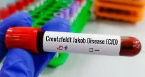 Entenda a Doen�a de Creutzfeldt-Jakob e o diagn�stico do piloto Lito Souza