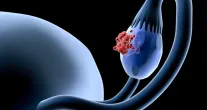 C�ncer de ov�rio: 5 sinais comuns que as mulheres n�o devem ignorar