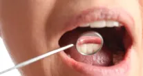Por que seu t�rtaro volta t�o r�pido? Dentista revela o segredo da sua saliva