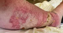 Perna de idoso inchou at� o tamanho de uma melancia ap�s mordida de aranha no Reino Unido