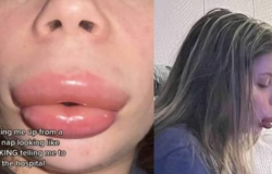 Mulher fica com 'boca de pato' aps alergia a preenchimento labial