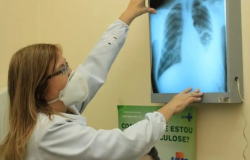 Brasil amplia preveno e adota tratamentos inovadores para eliminar a tuberculose