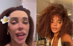 Brunna Gonalves faz cirurgia plstica para reduzir a testa e cirurgio explica o procedimento