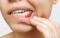 Cncer de boca est entre os mais incidentes no Brasil