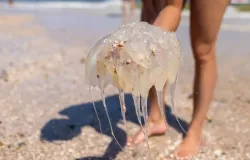 Como tratar uma queimadura de �gua-viva em crian�as?