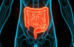 C�ncer de intestino em jovens aumenta e preocupa m�dicos