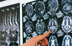 Diagn�stico de esclerose m�ltipla: especialistas explicam como tratar e manter a autonomia