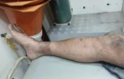 Homem de 39 anos sofre choque el�trico grave ao testar gerador em fazenda