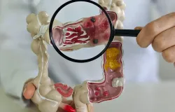 Doen�as do intestino saltam 5 vezes no Brasil e alarmam m�dicos