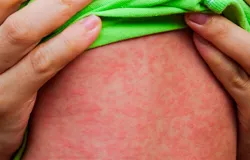 Estado de S�o Paulo registra primeiro caso de sarampo em 2026