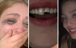 Jovem quebra o dente em festa no Paran�, cola o dente de madrugada e volta para se divertir