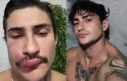 Influenciador 'Ken Humano' � internado depois de espremer uma espinha no rosto