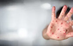 Sarampo: tire suas d�vidas e saiba como se vacinar