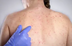 Casos de sarampo sobem para 16 em S�o Paulo