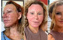 Mulher mostra como � a recupera��o de uma cirurgia pl�stica sem esconder nada