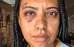 Influenciadora � agredida em roda de samba no Rio e leva seis pontos no superc�lio