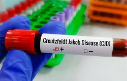 Entenda a Doen�a de Creutzfeldt-Jakob e o diagn�stico do piloto Lito Souza
