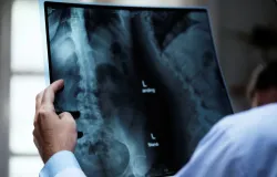 Osteoporose afeta homens e mulheres de formas diferentes: veja como prevenir a perda dos ossos