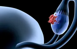 C�ncer de ov�rio: 5 sinais comuns que as mulheres n�o devem ignorar