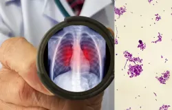 Morte em laborat�rio na R�ssia reacende alerta para peste pneum�nica