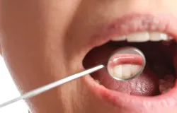 Por que seu t�rtaro volta t�o r�pido? Dentista revela o segredo da sua saliva