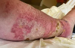 Perna de idoso inchou at� o tamanho de uma melancia ap�s mordida de aranha no Reino Unido