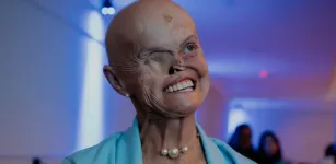 Mulher brasileira vence 73 c�nceres de pele e busca reconstruir o rosto
