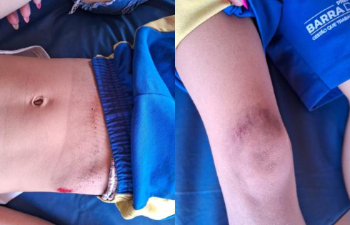 Jovem sem CNH atropela criana e foge sem prestar socorro em Barra do Garas