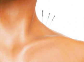 Dor no ombro e acupuntura
