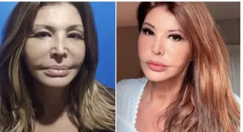 Lembra dela? Musa dos anos 90 recorre  harmonizao facial