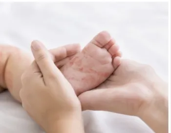 Primavera do Leste confirma 6� caso de sarampo; crian�a de 1 ano n�o era vacinada