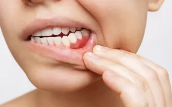 Cncer de boca est entre os mais incidentes no Brasil