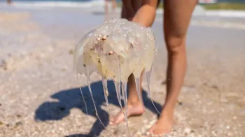 Como tratar uma queimadura de �gua-viva em crian�as?