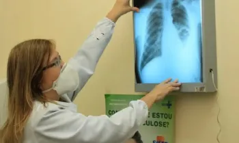 Brasil amplia preveno e adota tratamentos inovadores para eliminar a tuberculose