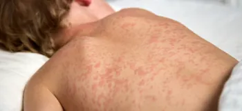 Cuiab� emite alerta para risco de sarampo e refor�a import�ncia da vacina��o