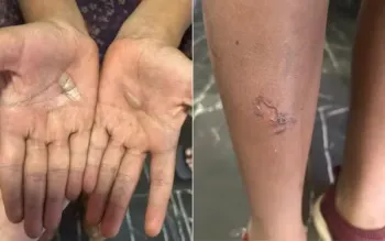 Meninas de 11 e 12 anos apresentam queimaduras ap�s supostas agress�es cometidas pelo pai, em �guas Lindas de Goi�s