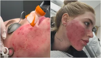 Virginia choca internautas ao mostrar pele queimada ap�s procedimentos� Instagram / Virginia
